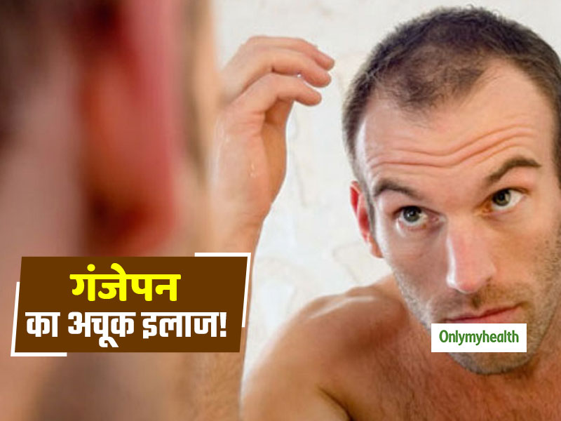 How To Stop Hair Fall: पुरुषों में बाल झड़ने और गंजेपन से निजात दिलाएंगे ये 5 आयुर्वेदिक उपचार 
