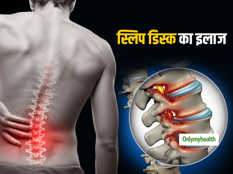 know-about-non-surgical-treatment-option-for-slipped-disc-in-hindi