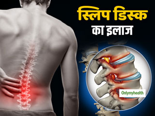 Slip Disc Treatment: बिना सर्जरी के भी किया जा सकता है स्लिप्ड डिस्क का उपचार