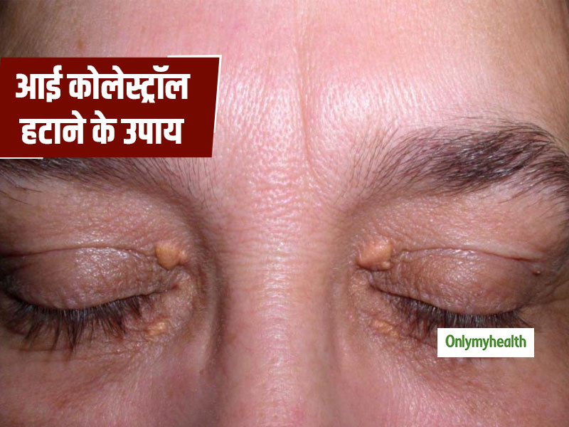 आंखों के नीचे जमा होने वाले कोलेस्ट्रॉल के कारण और घरेलू उपचार  
