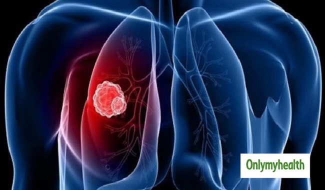 Lung Cancer: 5 Things Causing Damage To Your Lungs