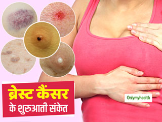 सिर्फ गांठ नहीं, ये 6 लक्षण भी हो सकते हैं स्तन कैंसर (ब्रेस्ट कैंसर) का शुरुआती संकेत, जानें कैसे पहचानें इन्हें