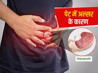 पेट में अल्‍सर होने का कारण है दूषित और ज्‍यादा मसालेदार भोजन, जानें 'पेप्टिक अल्‍सर' के प्रकार और लक्षण