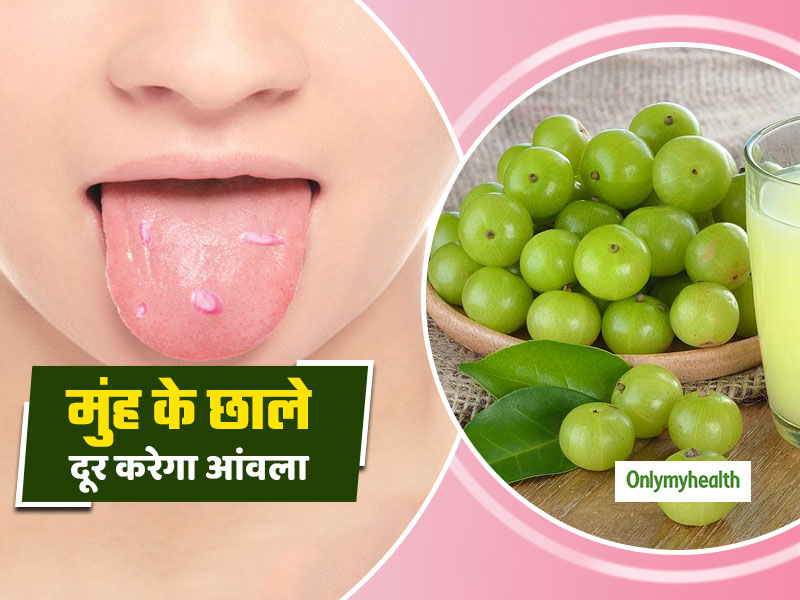 मुंह के छालों को दूर करना है तो इस तरह करें आंवला का सेवन, चंद दिनों में दिखेगा असर