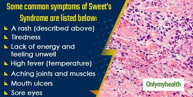 Not So Sweet In Nature, Sweet’s Syndrome Is A Rare Skin Disorder ...