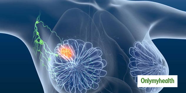 Inside_dye and breast cancer