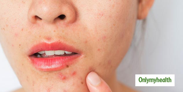 Acne Problem