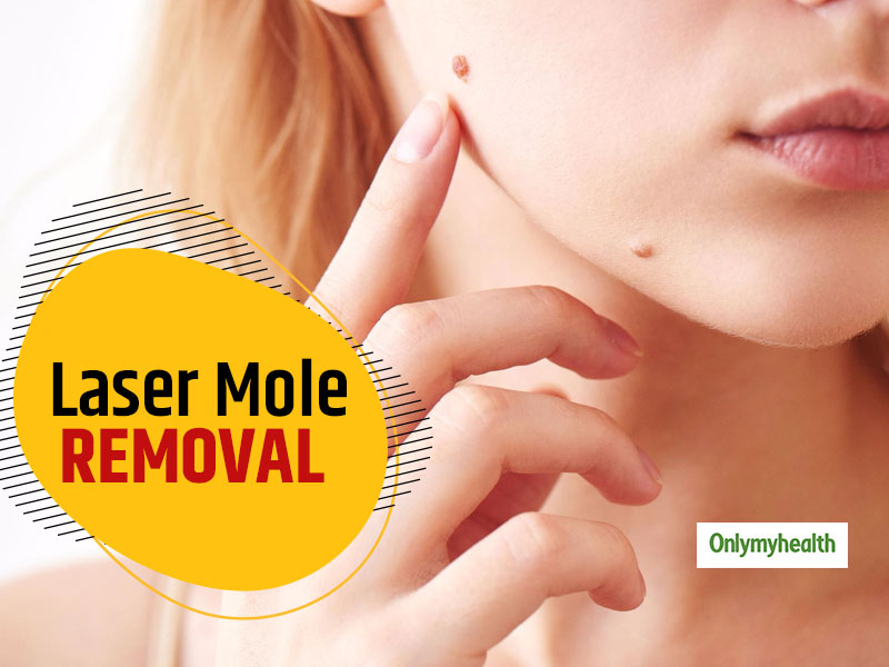 All You Need To Know About Laser Mole Removal