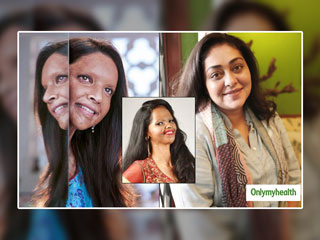 दीपिका पादुकोण की एसिड अटैक पर बनी फिल्म 'छपाक' हुई रिलीज, जानें एसिड गिरने पर क्या हो फर्स्ट एड