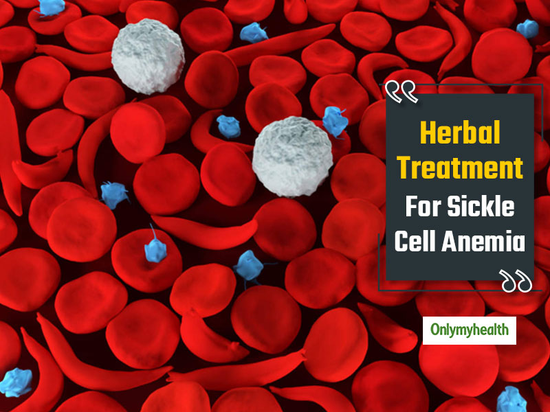 Herbal Treatment For Sickle Cell Anemia Sailin Hbs Helpful In Anemia Management Onlymyhealth 