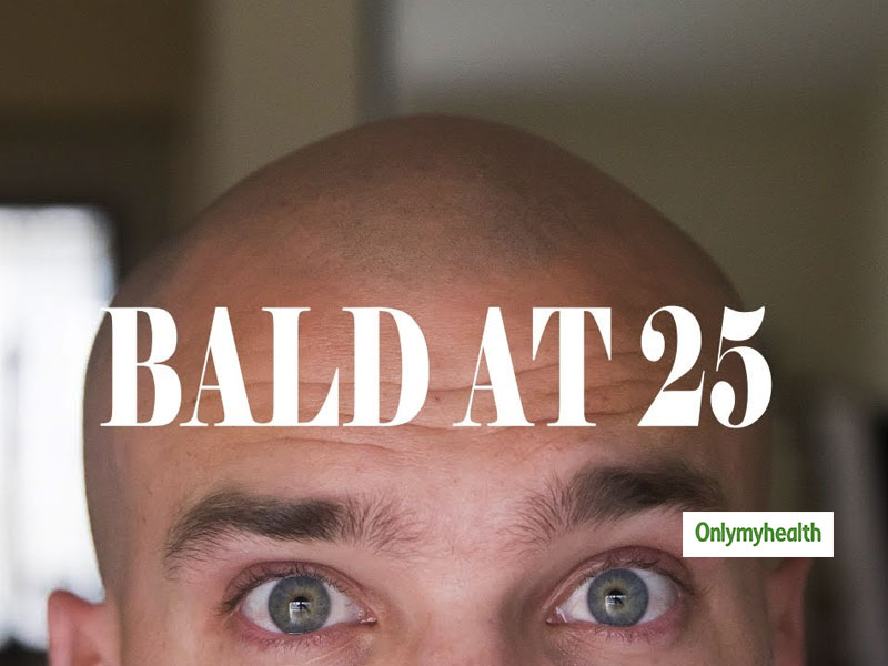 Is It Normal To Go Bald At The Age Of 25? Let's Find Out