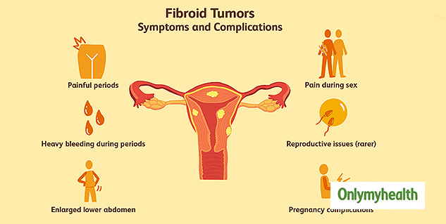 True Story: 16 Kg Fibroids Tumour Removed, 29-year-old Finds Relief 