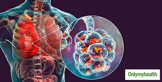 Pneumonia