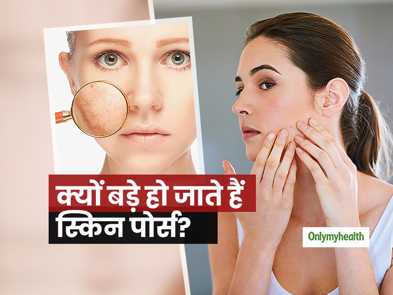 स्किन की कई परेशानियों का कारण होते हैं त्वचा के बड़े होते पोर्स, कारण और बचाव के तरीके