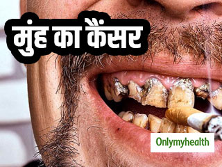 विश्व कैंसर दिवस : मप्र में हर साल मुंह और फेफड़े के कैंसर से मरते हैं हजारों लोग, जानें बचाव के तरीके