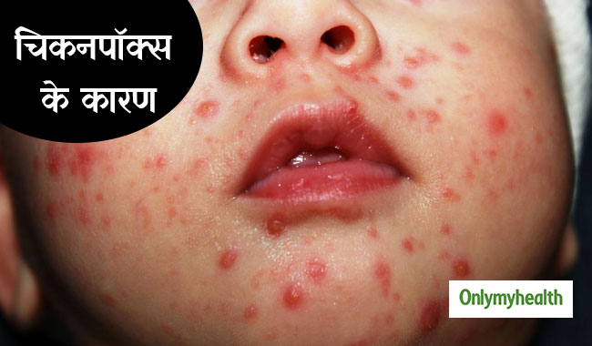 बदलते मौसम में बढ़ जाता है चिकनपॉक्स का खतरा, ये 5 कारण हैं इसके लिए जिम्मेदार