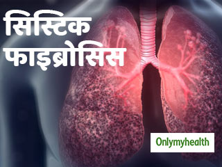 सिस्टिक फाइब्रोसिस में कब पड़ती है लंग्स ट्रांसप्लांट की जरूरत, जानें जरूरी बातें