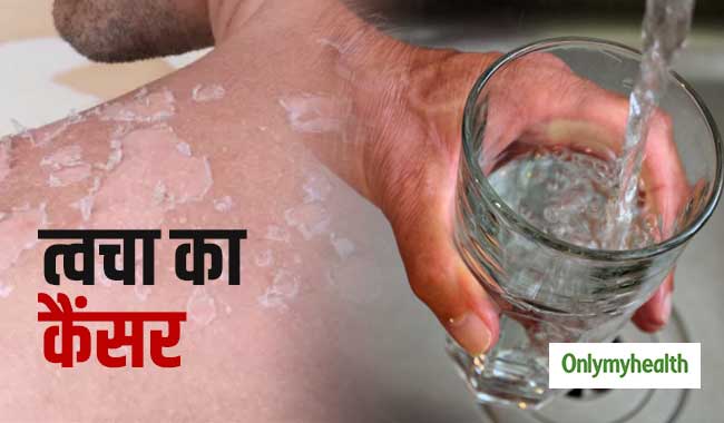 दिल्ली में जल प्रदूषण से बढ़ रहा है त्वचा कैंसर का खतरा, जानें कैसे बचे इससे