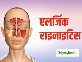 एलर्जिक राइनाइटिस के लक्षण हैं नाक में खुजली और दर्द होना, जानें बचाव के तरीके