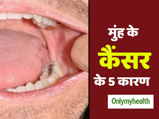 सिर्फ तंबाकू नहीं, इन 5 कारणों से भी हो सकता है मुंह का कैंसर