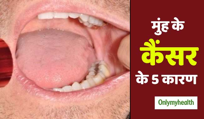 सिर्फ तंबाकू नहीं, इन 5 कारणों से भी हो सकता है मुंह का कैंसर