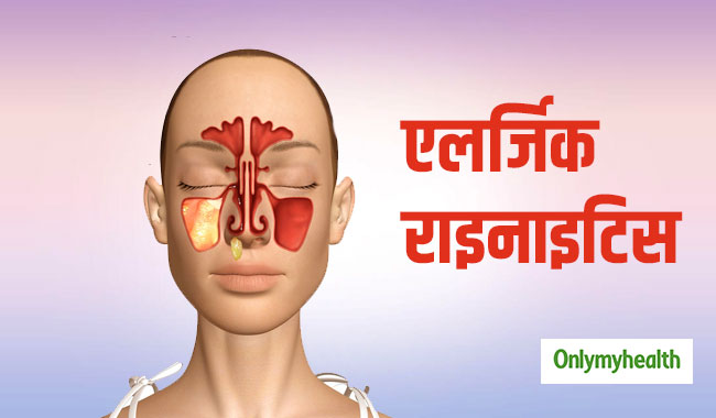 एलर्जिक राइनाइटिस के लक्षण हैं नाक में खुजली और दर्द होना, जानें बचाव के तरीके