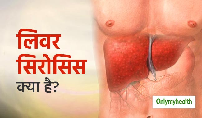 लिवर सिरोसिस का संकेत है पेट में सूजन और दर्द, जानें क्‍या है इस गंभीर बीमारी की वजह 