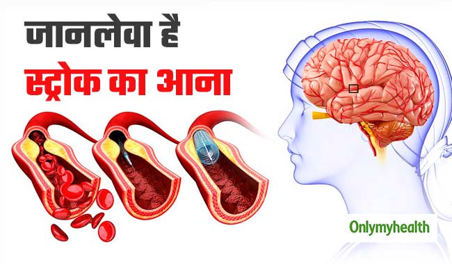 स्‍ट्रोक आने पर मस्तिष्‍क में रूक जाता है खून का प्रवाह, हाई ब्‍लड प्रेशर है इसकी वजह  
