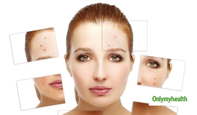 5 Home Remedies to Get Rid of Acne Overnight 