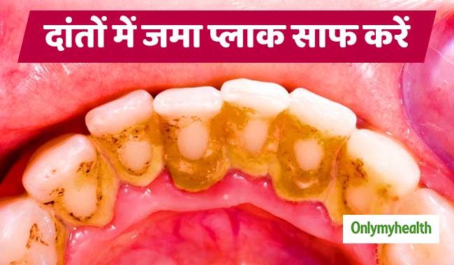दांतों में जमा 'प्लाक' मसूड़ों और मुंह के रोगों का बनता है कारण, इन 5 तरीकों से करें साफ