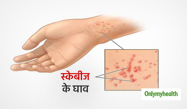 छूने से भी फैल सकता है स्‍केबीज रोग, जानें कारण और बचाव 