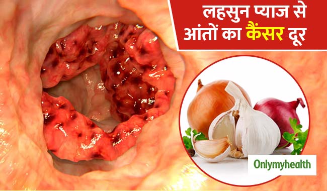 लहसुन और प्याज खाने से कम होता है आंतों के कैंसर का खतरा: शोध