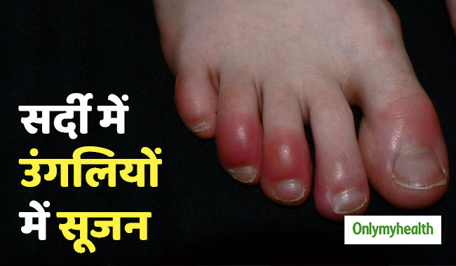 सर्दियों में हाथ-पैरों में सूजन का कारण हो सकते हैं चिलब्लेन्स, जानें लक्षण और उपचार