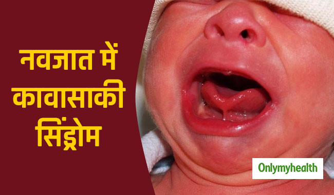 सर्दियों में शिशु की जीभ सूजने का कारण हो सकता है कावासाकी सिंड्रोम, जानें कितना खतरनाक है ये?