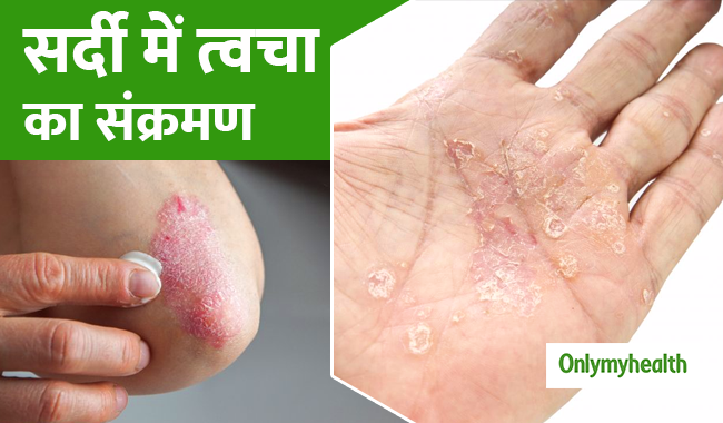 सर्दियों में बढ़ जाती हैं त्वचा इंफेक्शन की समस्याएं, इन 4 टिप्स से करें बचाव