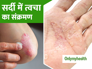 सर्दियों में बढ़ जाती हैं त्वचा इंफेक्शन की समस्याएं, इन 4 टिप्स से करें बचाव