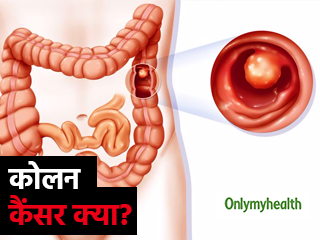 मल में खून आना कोलन कैंसर के हैं संकेत है, जानें क्‍या है ये बीमारी और बचाव 