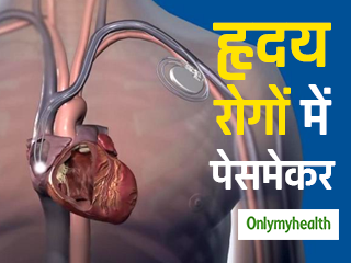 हार्ट के रोगों में कब पड़ती है पेसमेकर लगाने की जरूरत, जानें कैसे होती है सर्जरी