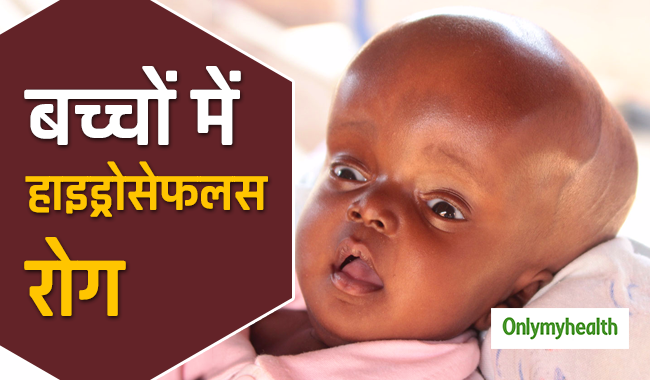 बच्चों में खतरनाक बीमारी हाइड्रोसेफलस के ये हैं लक्षण, मस्तिष्क में भर जाता है द्रव