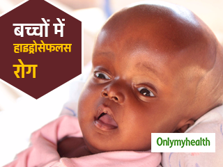 बच्चों में खतरनाक बीमारी हाइड्रोसेफलस के ये हैं लक्षण, मस्तिष्क में भर जाता है द्रव
