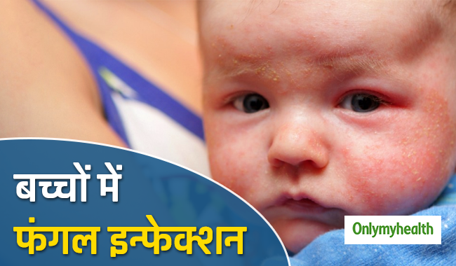 बच्चों में वाइट स्किन पैचेस फंगल इन्फेक्शन के हैं संकेत, जानें कारण और बचाव