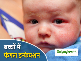 बच्चों में वाइट स्किन पैचेस फंगल इन्फेक्शन के हैं संकेत, जानें कारण और बचाव