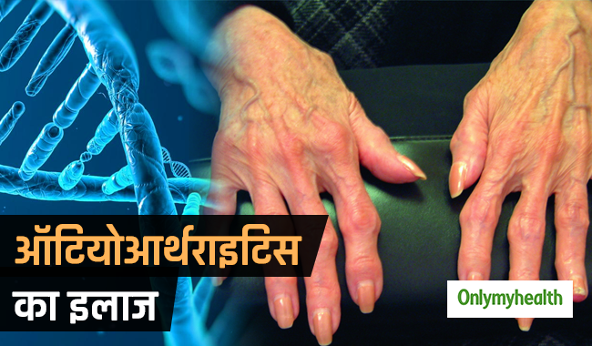 ऑटियोआर्थराइटिस के इलाज के लिए जीन की हो सकती है महत्‍वपूर्ण भूमिका: शोध