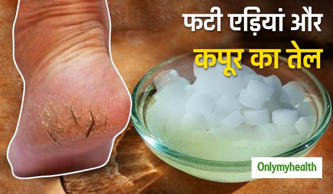 फटी एड़ियों और होठों को 1 रात में सही करता है कपूर का तेल, ऐसे बनाएं घर पर