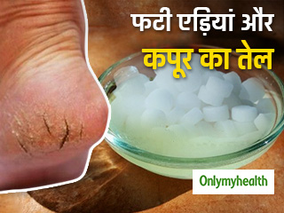 फटी एड़ियों और होठों को 1 रात में सही करता है कपूर का तेल, ऐसे बनाएं घर पर