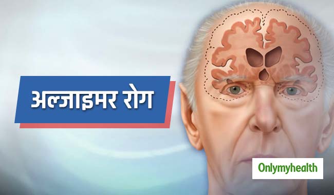 वैज्ञानिकों का दावा, अल्‍जाइमर रोगी की खोई हुई याददाश्‍त का वापस आना संभव  