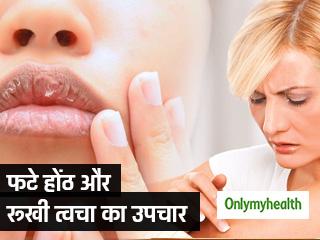 फटे होंठ और रूखी त्‍वचा से रातोंरात छुटकारा दिलाते हैं ये 5 आसान उपाय