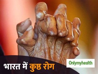 कुष्ठ रोग के 60% से ज्यादा मामले भारत में, बिहार और यूपी में हैं सबसे ज्यादा मरीज