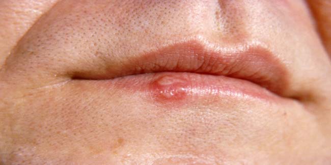 How To Prevent A Cold Sore From Coming Out