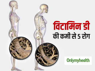विटामिन डी की कमी से कमजोर हड्डियों, कैंसर और ब्लड प्रेशर जैसी बीमारियों का खतरा, जानें स्रोत